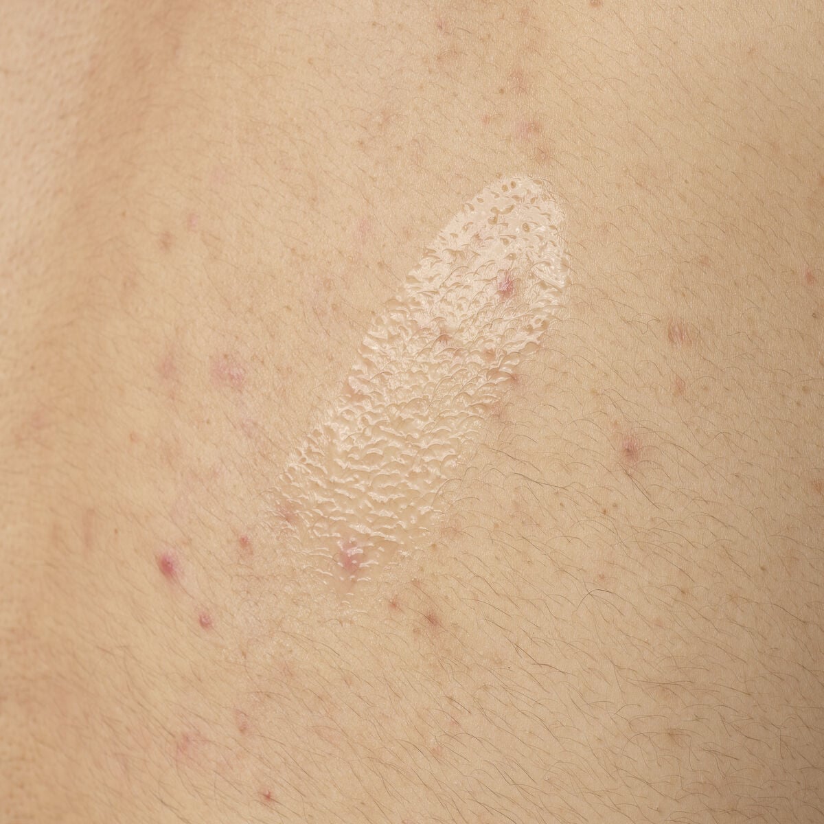 salicylic-acid-0-5-body-serum-q8 ORD-salicylic-acid-05-body-240ml-application.jpg