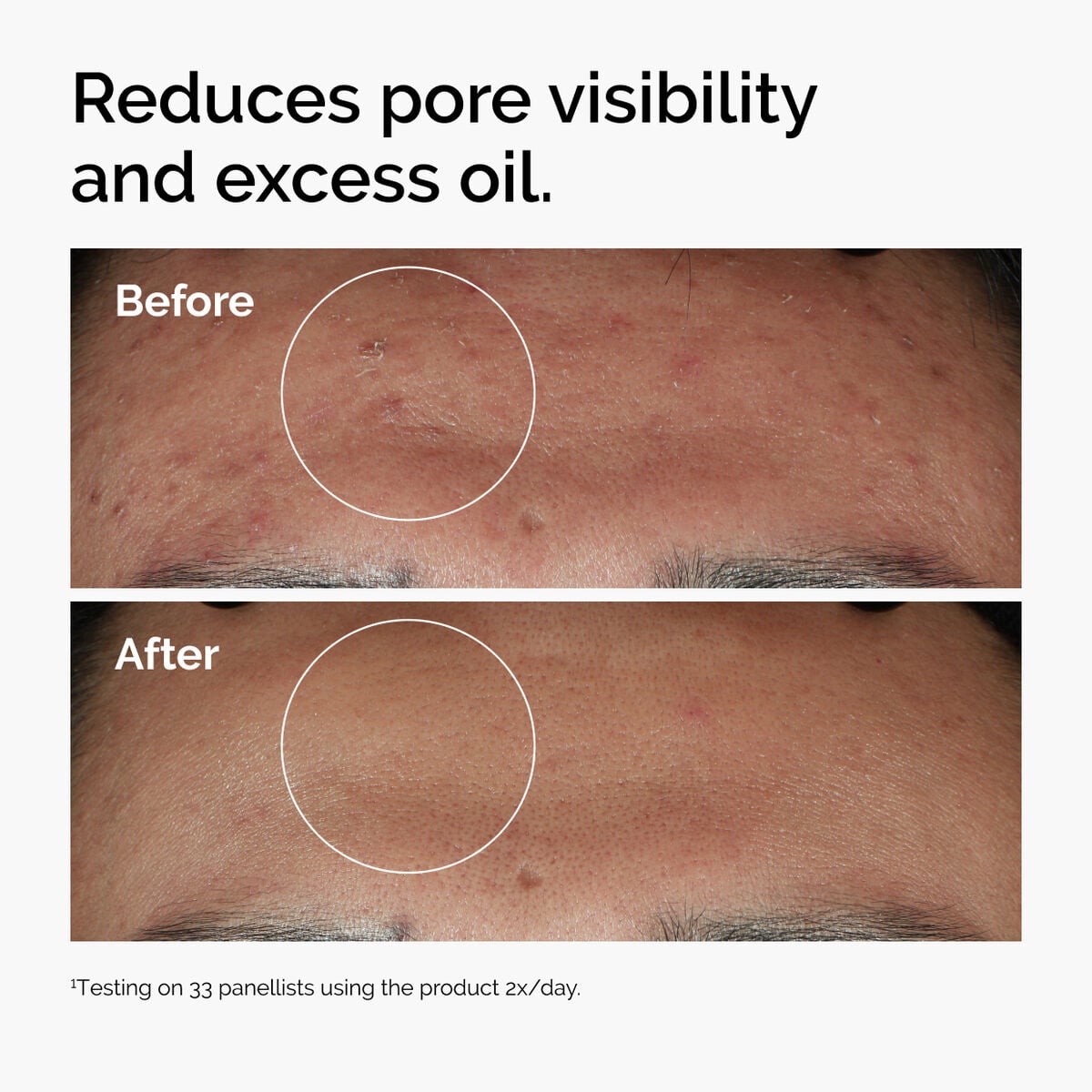 niacinamide-10-zinc-1-d0 ord-niacinamide-zinc-blemish-serum-before-after-pores.jpg