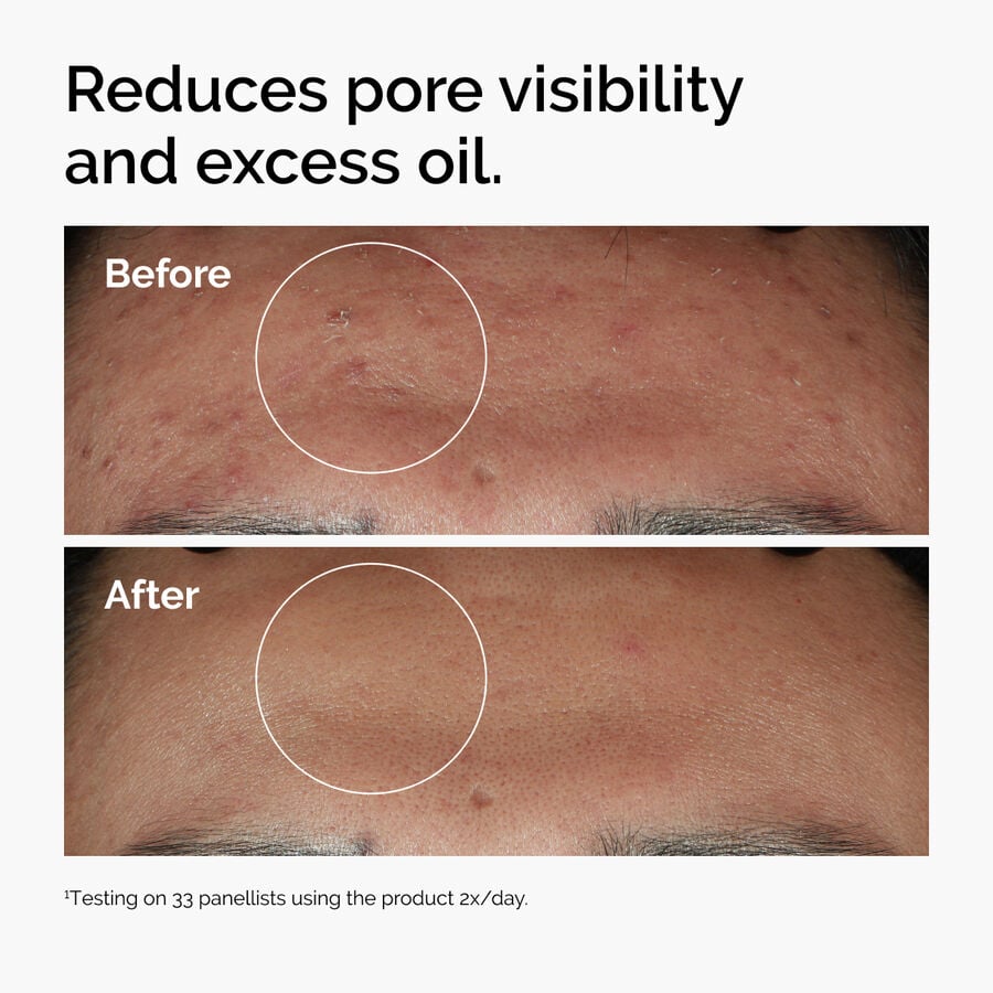 niacinamide-10-zinc-1-d0 ord-niacinamide-zinc-blemish-serum-before-after-pores.jpg
