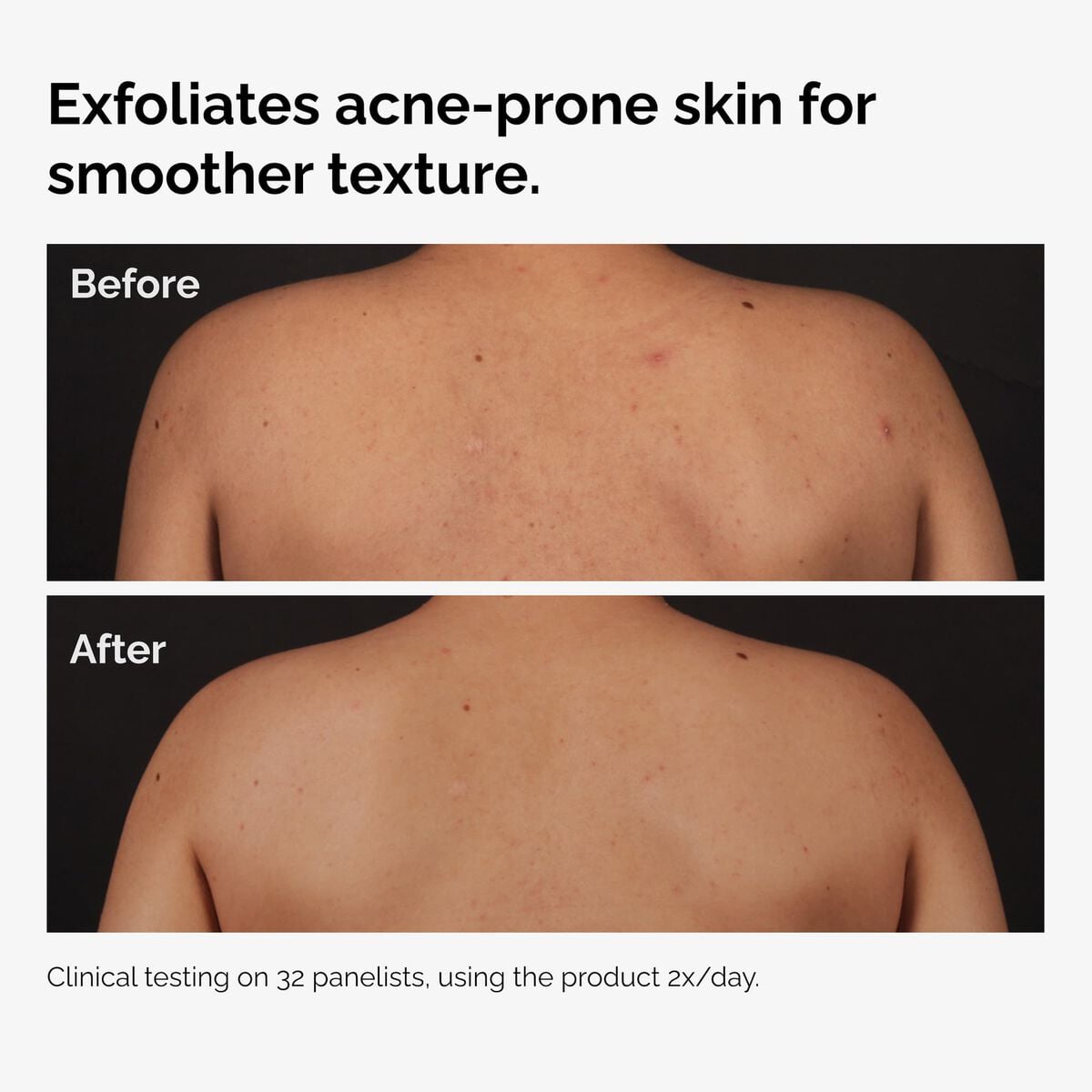 salicylic-acid-0-5-body-serum-q8 ord-salicylic-acid-body-serum-before-after-graphic-NA.jpg
