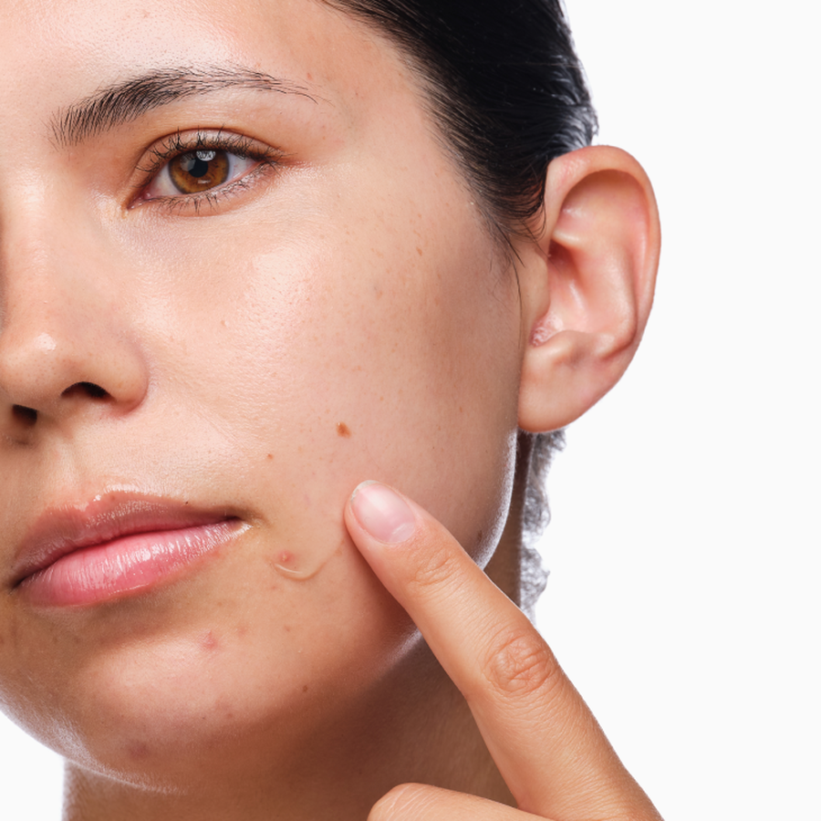 the-acne-set-a1 rdn-the-acne-set-application.png